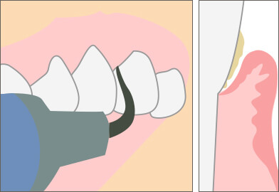 スケーリングで歯周病の抑制・改善